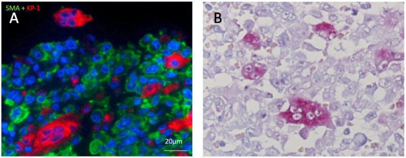 A: 破骨細胞様巨細胞(red, KP-1), 平滑筋肉腫細胞(green, α-SMA), B: 破骨細胞様巨細胞はピンク色(酒石酸抵抗性酸性ホスファターゼ陽性)