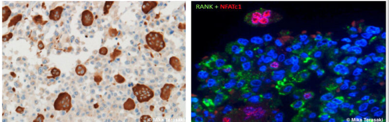 左：破骨細胞様巨細胞はKP-1(Møマーカー)陽性
右: 破骨細胞様巨細胞の核に破骨細胞分化の転写因子NFATc1陽性(red)