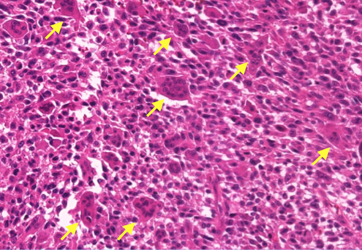 破骨細胞様巨細胞を伴う平滑筋肉腫
(黄色矢印：破骨細胞様巨細胞)