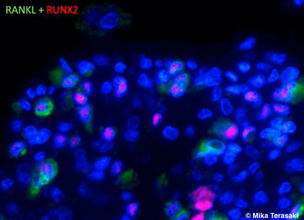 平滑筋肉腫細胞は、RUNX2(red), RANKL(green)陽性である